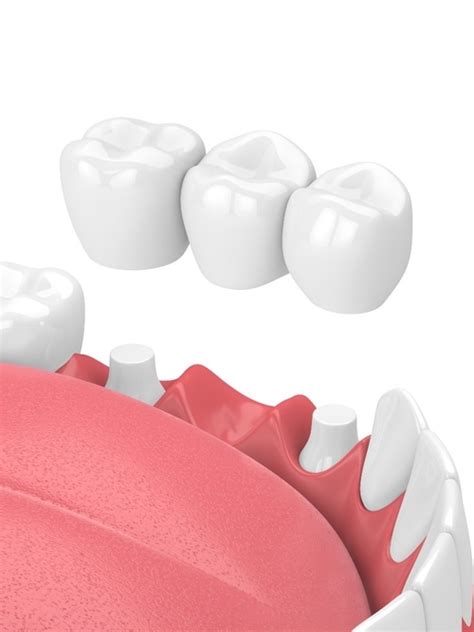 dental bridges arvada|Tooth Bridge in Arvada, CO .